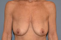 Breast Augmentation Lift Before & After Gallery - Patient 263645 - Image 1