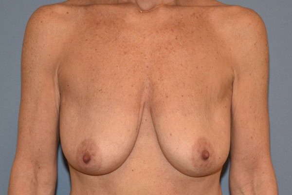 Breast Augmentation Lift Before & After Gallery - Patient 263645 - Image 1