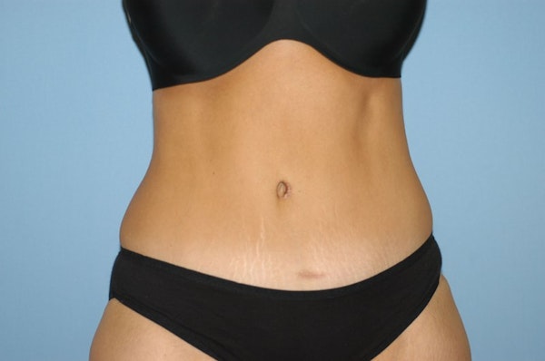 Before and After Abdominoplasty in Long Island