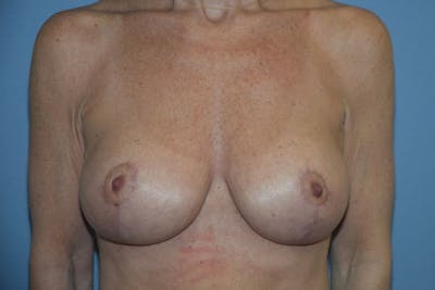 Breast Augmentation Lift Before & After Gallery - Patient 263645 - Image 2