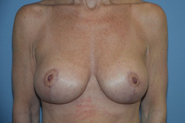 Breast Augmentation Lift Before & After Gallery - Patient 263645 - Image 2