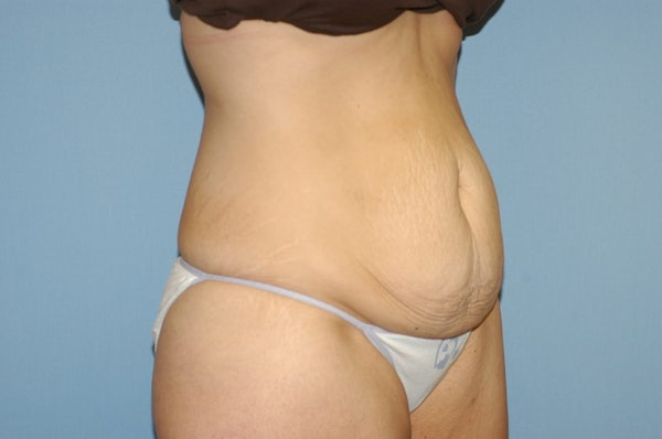 Tummy Tuck Before & After Gallery - Patient 289847 - Image 3