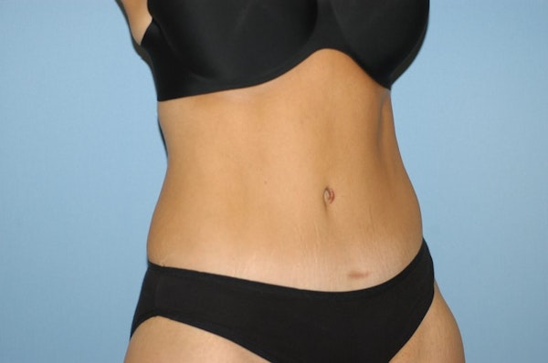 Tummy Tuck Before & After Gallery - Patient 289847 - Image 4