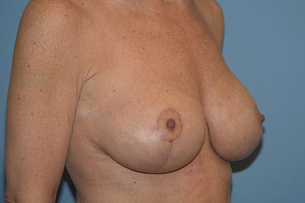 Breast Augmentation Lift Before & After Gallery - Patient 263645 - Image 4