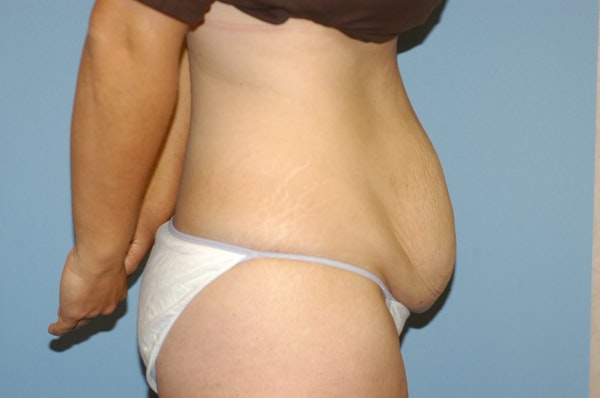 Tummy Tuck Before & After Gallery - Patient 289847 - Image 5