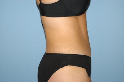 Tummy Tuck Before & After Gallery - Patient 289847 - Image 6