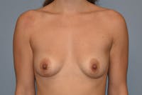 Breast Augmentation Before & After Gallery - Patient 334549 - Image 1