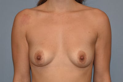 Breast Augmentation Before & After Gallery - Patient 334549 - Image 1