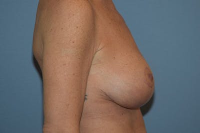Breast Augmentation Lift Before & After Gallery - Patient 263645 - Image 6