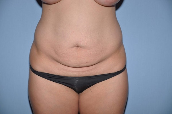 Tummy Tuck Before & After Gallery - Patient 405007 - Image 1