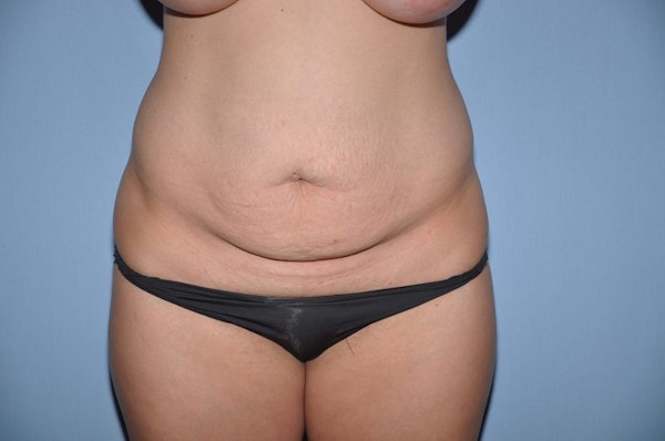 Before and After Abdominoplasty in Long Island