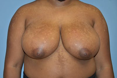 Breast Reduction Before & After Gallery - Patient 245086 - Image 1