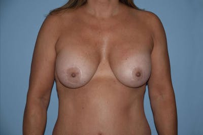 Breast Augmentation Lift Before & After Gallery - Patient 160718 - Image 2