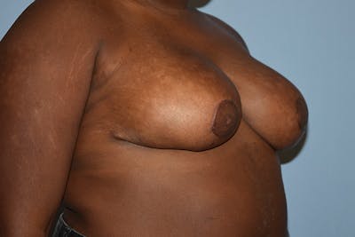 Breast Reduction Before & After Gallery - Patient 245086 - Image 4