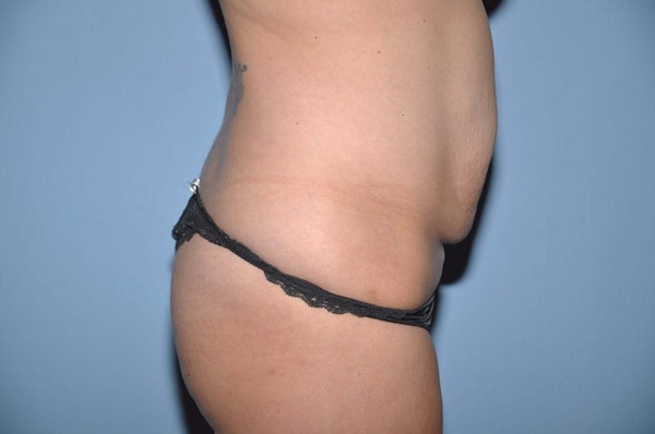 Tummy Tuck Before & After Gallery - Patient 405007 - Image 5
