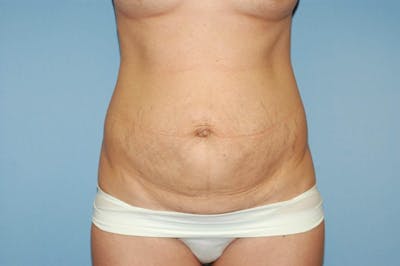 Tummy Tuck Before & After Gallery - Patient 372602 - Image 1