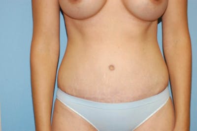 Tummy Tuck Before & After Gallery - Patient 372602 - Image 2