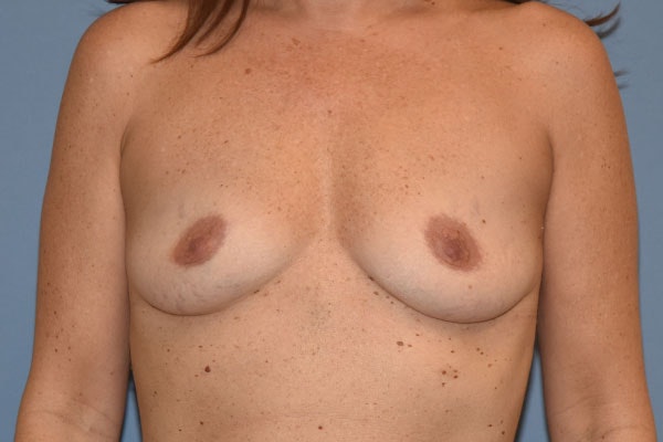 Breast Augmentation Before & After Gallery - Patient 220737 - Image 1