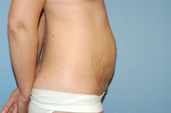 Tummy Tuck Before & After Gallery - Patient 372602 - Image 5