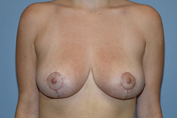 Breast Lift Before & After Gallery - Patient 422574 - Image 2