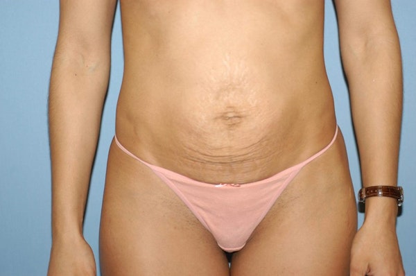 Tummy Tuck Before & After Gallery - Patient 665560 - Image 1