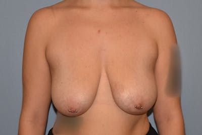 Breast Reduction Before & After Gallery - Patient 329492 - Image 1