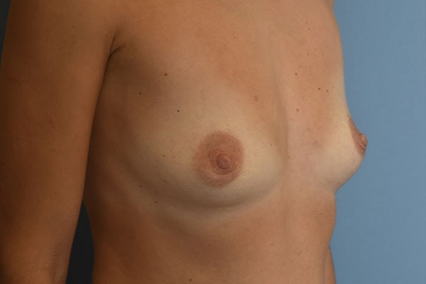 Breast Augmentation Before & After Gallery - Patient 392075 - Image 3