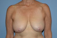 Breast Lift Before & After Gallery - Patient 128620 - Image 1