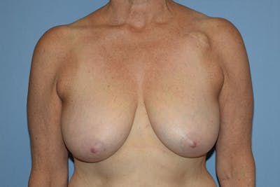 Breast Lift Before & After Gallery - Patient 128620 - Image 1