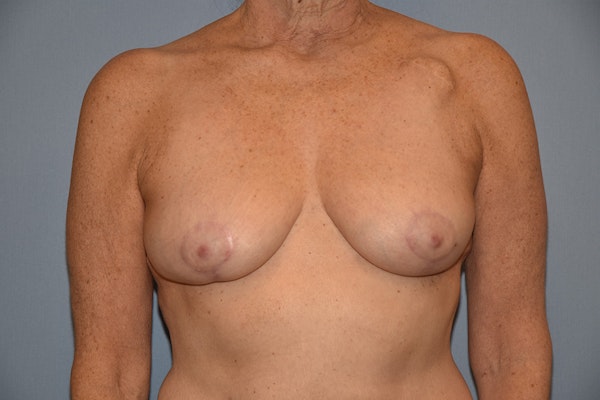 Breast Lift Before & After Gallery - Patient 128620 - Image 2