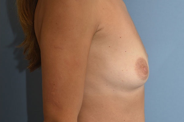 Breast Augmentation Before & After Gallery - Patient 392075 - Image 5