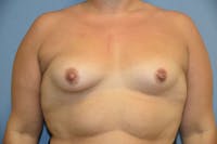 Breast Augmentation Before & After Gallery - Patient 350487 - Image 1