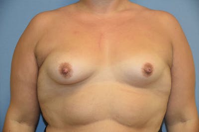 Breast Augmentation Before & After Gallery - Patient 350487 - Image 1