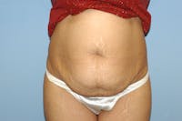 Tummy Tuck Before & After Gallery - Patient 400601 - Image 1