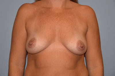 Breast Augmentation Before & After Gallery - Patient 160677 - Image 1