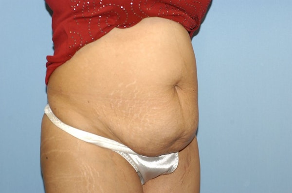 Tummy Tuck Before & After Gallery - Patient 400601 - Image 3