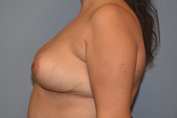 Breast Reduction Before & After Gallery - Patient 342510 - Image 6