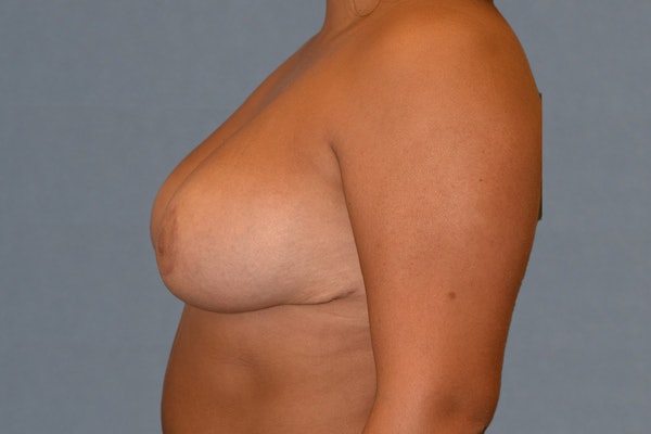 Breast Lift Before & After Gallery - Patient 249251 - Image 6