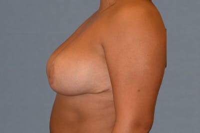 Breast Lift Before & After Gallery - Patient 249251 - Image 6