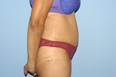 Tummy Tuck Before & After Gallery - Patient 400601 - Image 6