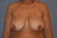 Breast Reduction Before & After Gallery - Patient 108875 - Image 1