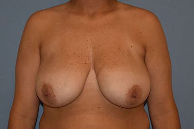 Breast Reduction Before & After Gallery - Patient 108875 - Image 1