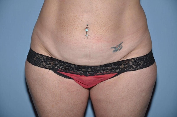 Tummy Tuck Before & After Gallery - Patient 377796 - Image 1