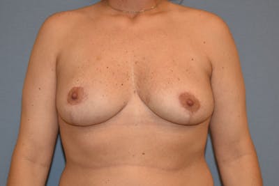 Breast Reduction Before & After Gallery - Patient 108875 - Image 2
