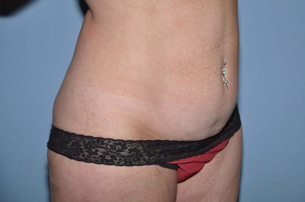 Tummy Tuck Before & After Gallery - Patient 377796 - Image 3