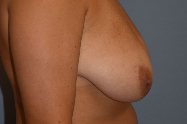 Breast Reduction Before & After Gallery - Patient 108875 - Image 5