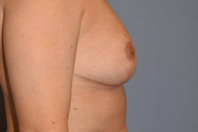 Breast Reduction Before & After Gallery - Patient 108875 - Image 6