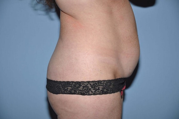 Tummy Tuck Before & After Gallery - Patient 377796 - Image 5