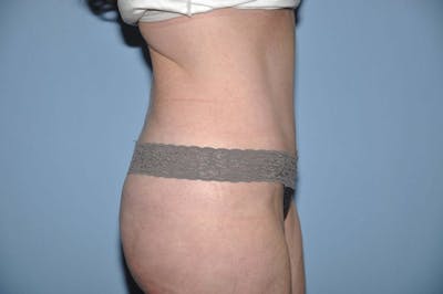 Tummy Tuck Before & After Gallery - Patient 377796 - Image 6