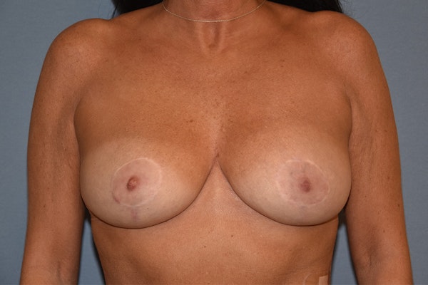 Breast Reduction Before & After Gallery - Patient 109594 - Image 2